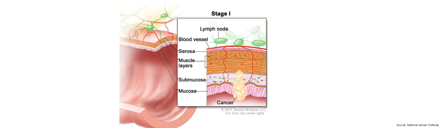 Bowel Cancer Staging Stage 1