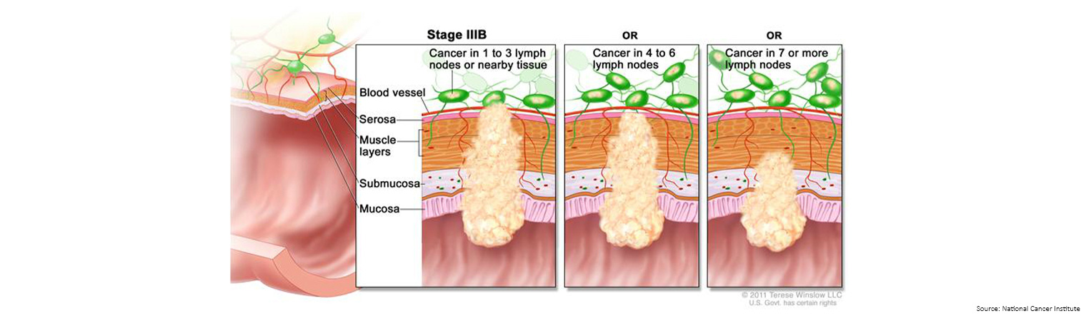 Bowel Cancer Staging Stage 3b