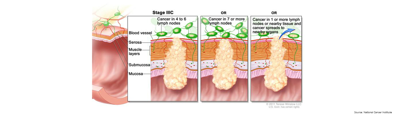 Bowel Cancer Staging Stage 3c