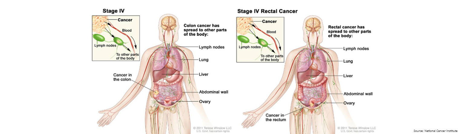 Bowel Cancer Staging Stage 4