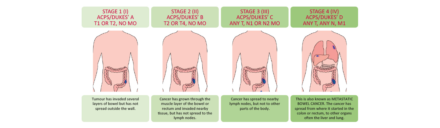 Bowel Cancer TNM Staging Systems 1