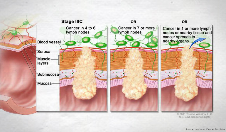 Bowel Cancer Staging Size Position And Spread