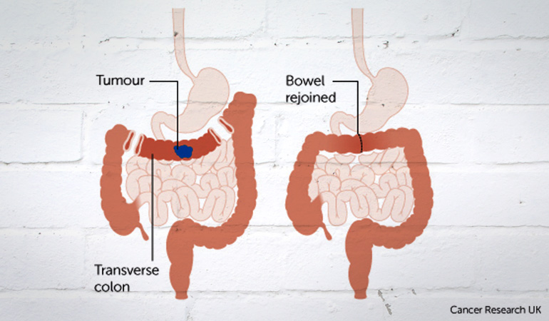 Effects Of Bowel Cancer On The Body - CancerWalls