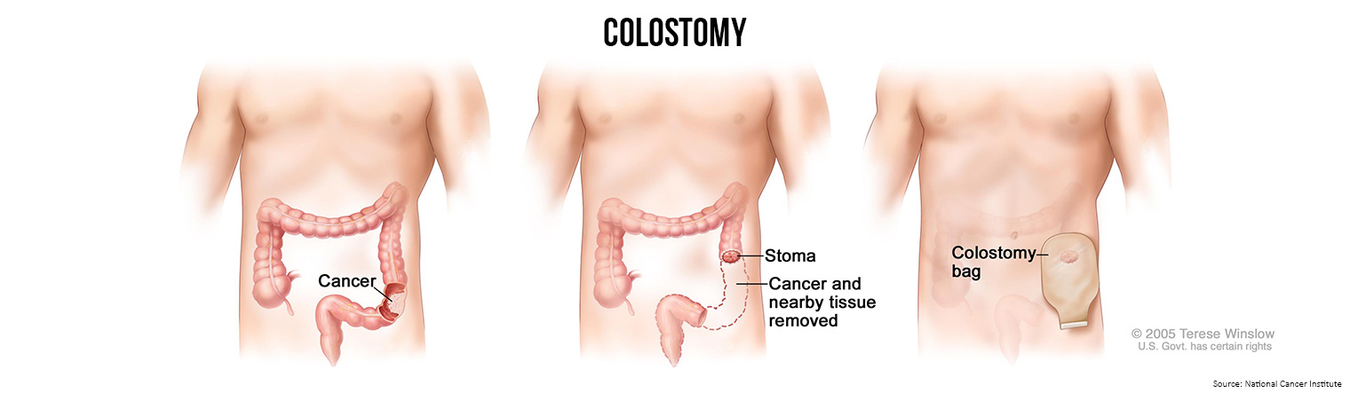 Bowel Cancer Treatment Colostomy