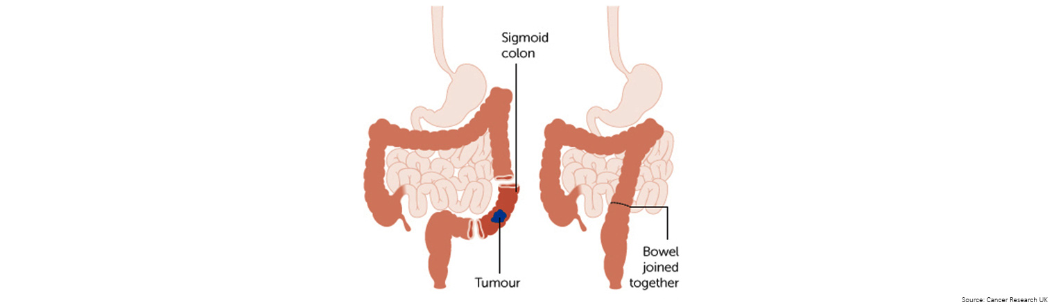 Bowel Cancer Treatment Sigmoid Tumor